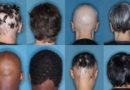 FDA aprova primeiro medicamento para alopecia que restaura o crescimento do cabelo em muitos pacientes